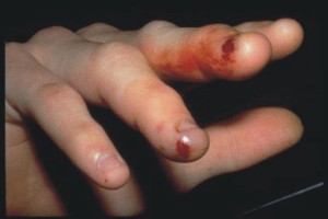 Human Bite