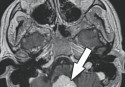 Apollo Hospitals Dhaka successfully operated a case of haemangioblastoma