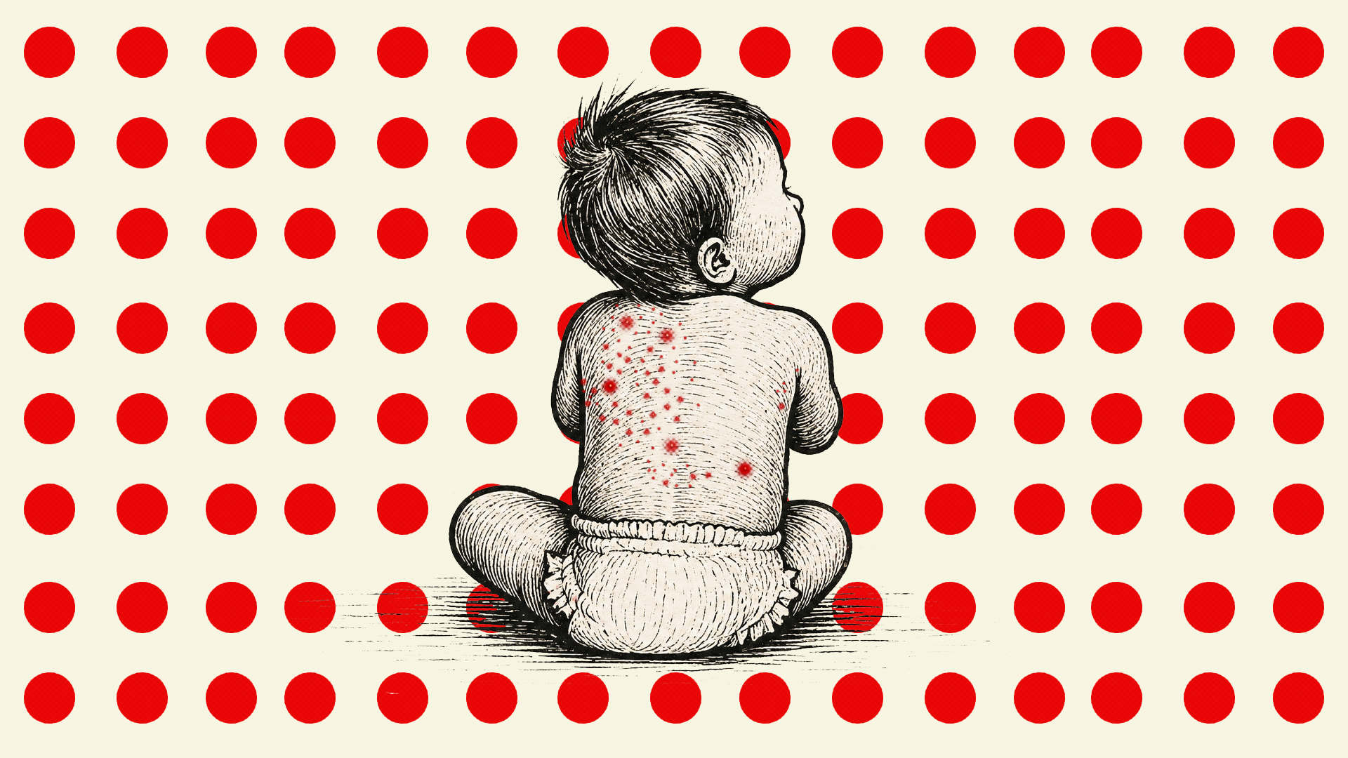 10 more die of measles, symptoms