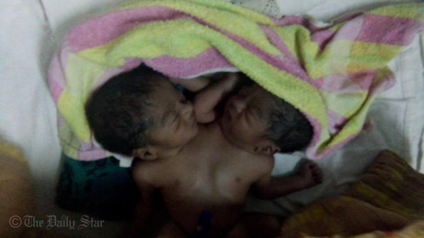 Conjoined twins with two heads,left deserted,at Dhaka Medical College and Hospital (DMCH),Pediatric Surgery unit,abandoned,relatives