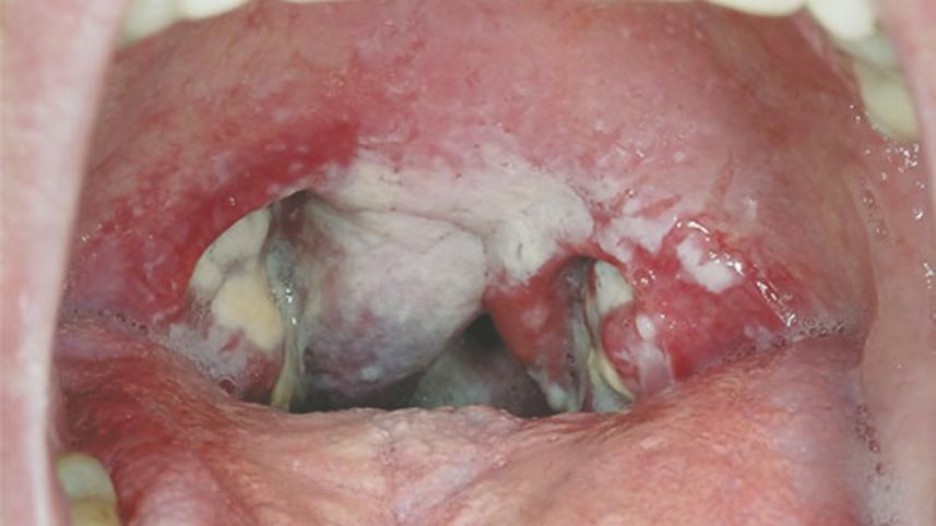 sore throat.jpg