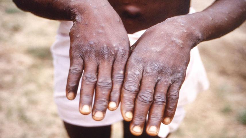 monkeypox.jpg