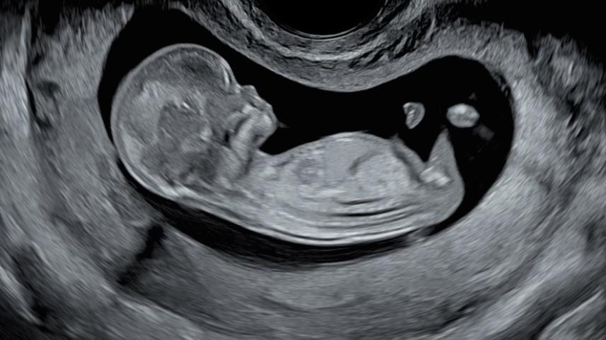 Foetus