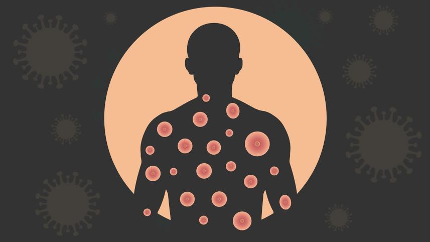 Mpox epidemic in Bangladesh 2024