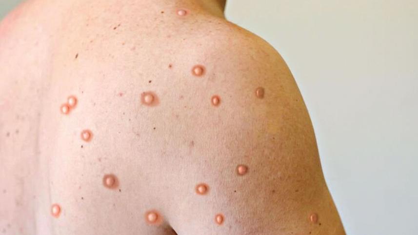mpox.jpg