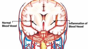 Cerebral vasculitis
