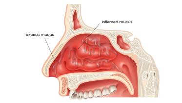nasal congestion