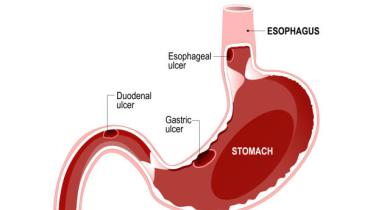 Following these diet recommendations will help ease the discomfort of ulcer during Ramadan. 