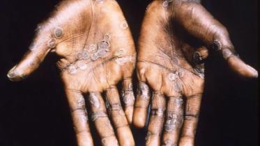 monkeypox-web.jpg