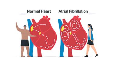 fibrillation.jpg