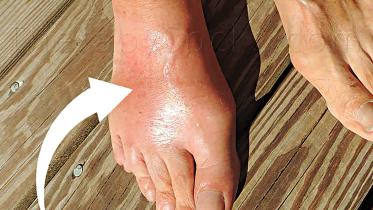 gout-management.jpg