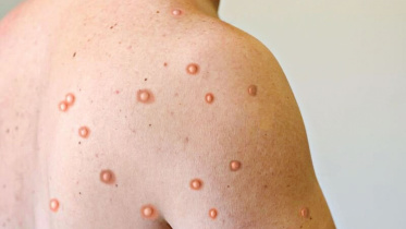 mpox.jpg
