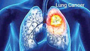 lung.jpg