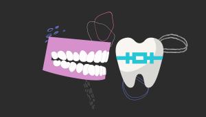 dental_brace.jpg
