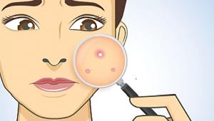 acne-occurs.jpg