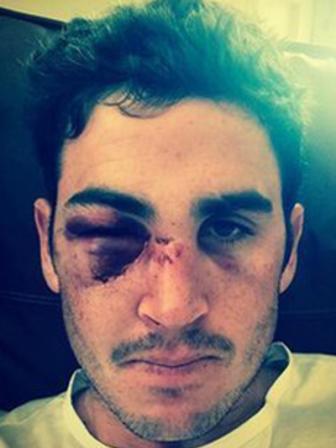 Eye-injury-forces-pic-two-NS.jpg