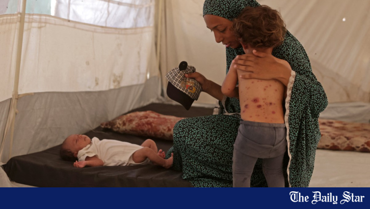 ‘Todas essas erupções cutâneas’: aumento da varicela nos campos de refugiados de Gaza ‘Todas essas erupções cutâneas’: aumento da varicela nos campos de refugiados de Gaza